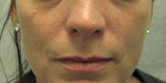 Restlane to the Lips before 935326