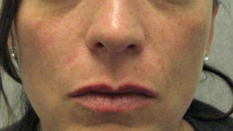 Restlane to the Lips after 935326