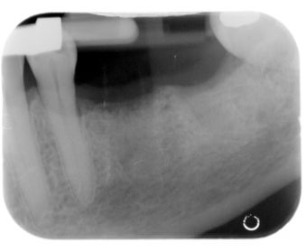 Mini dental implants support a dental bridge to replace missing teeth 1168524