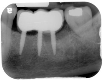 Mini dental implants support a dental bridge to replace missing teeth 1168524