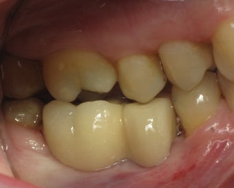 Mini dental implants support a dental bridge to replace missing teeth after 1168524