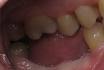 Mini dental implants support a dental bridge to replace missing teeth before 1168524
