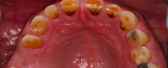 55-64 year old man treated with Dental Crown before 3395103