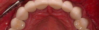 55-64 year old man treated with Dental Crown after 3395103