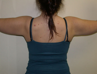 Arm Lift after 1233006