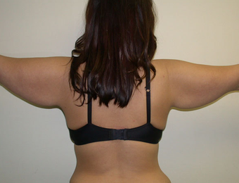 Arm Lift before 1233006