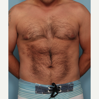 35-44 year old man treated with Fat Transfer after 3577843