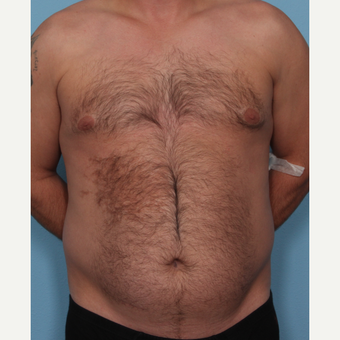 35-44 year old man treated with Fat Transfer before 3577843