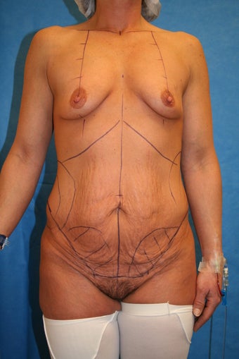 45 y/o With complaint of Mammary Hypoplasia (small breasts) and redundant Abdominal Wall Skin before 1240386