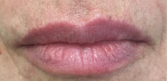 55-64 year old woman treated with Lip Lift after 3802392