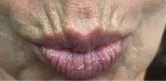 55-64 year old woman treated with Lip Lift 3802392