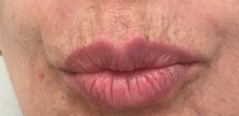 55-64 year old woman treated with Lip Lift 3802392