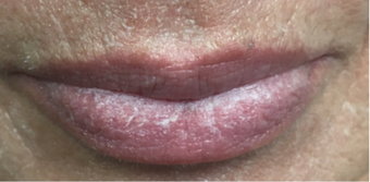 55-64 year old woman treated with Lip Lift before 3802392