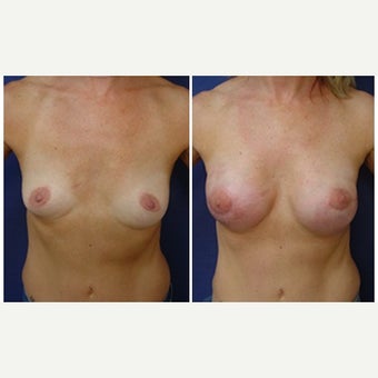 45-54 year old woman treated with Breast Reconstruction before 2050690
