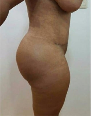 25-34 year old woman treated with Tummy Tuck after 3301070