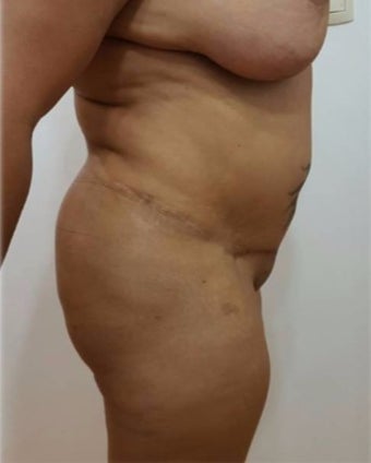 25-34 year old woman treated with Tummy Tuck before 3301070