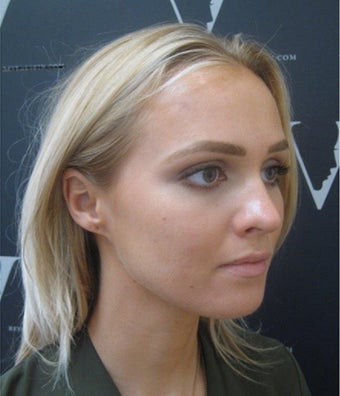 Get rid of acne for good with Revere skincare experts after 3107761
