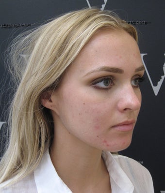 Get rid of acne for good with Revere skincare experts before 3107761