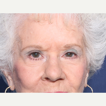 75 and up year old woman treated with Eyelid Surgery (view 1 of 2) after 3181065