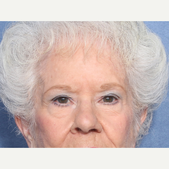 75 and up year old woman treated with Eyelid Surgery (view 1 of 2) before 3181065