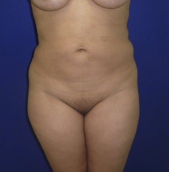 28 yo female BBL before 1295501