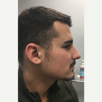 25-34 year old man treated with Microneedling after 3781954