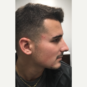 25-34 year old man treated with Microneedling before 3781954