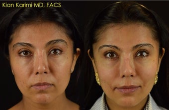 NovaThreads for Non-Surgical Cheek Lift and Corner of Mouth Tightening before 2629647