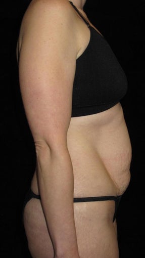 33 year old woman treated with Tummy Tuck 3093782