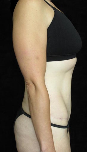 33 year old woman treated with Tummy Tuck 3093782