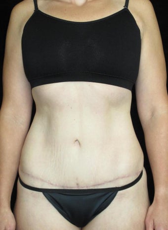 33 year old woman treated with Tummy Tuck after 3093782