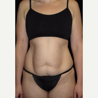 33 year old woman treated with Tummy Tuck before 3093782