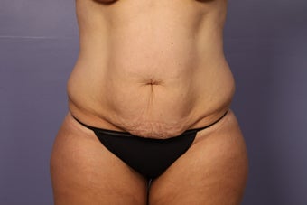 Tummy Tuck (abdominoplasty) before 1121653