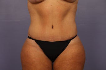 Tummy Tuck (abdominoplasty) after 1121653
