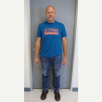 35-44 year old man treated with Sleeve Gastrectomy after 1987322