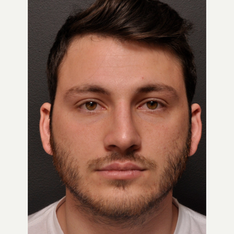 Male Rhinoplasty – Subtle changes while keeping Masculine Features after 3645104