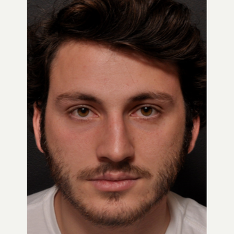 Male Rhinoplasty – Subtle changes while keeping Masculine Features before 3645104