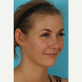 25-34 year old woman treated with Rhinoplasty after 3629411