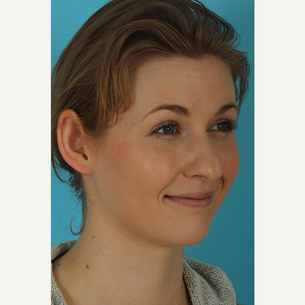 25-34 year old woman treated with Rhinoplasty before 3629411