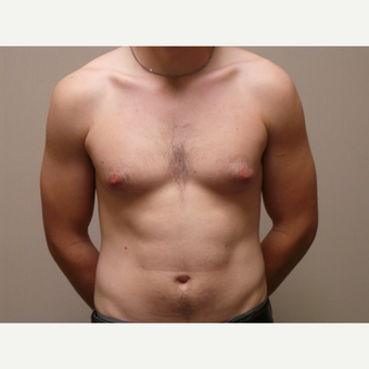 25-34 year old man treated with Male Breast Reduction before 3454687