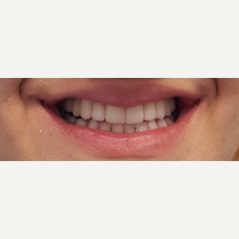 25-34 year old woman treated with Smile Makeover after 3306356