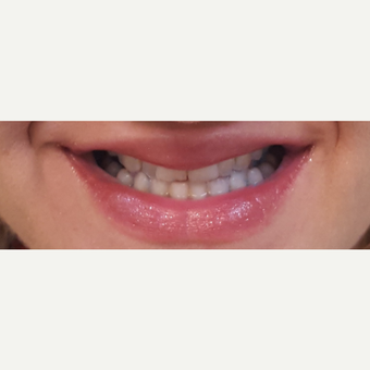 25-34 year old woman treated with Smile Makeover before 3306356
