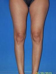 Calf Augmentation (Implants) before 1412148