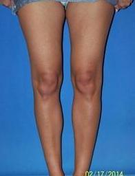 Calf Augmentation (Implants) after 1412148