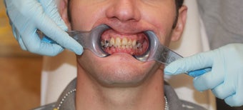 All-on-4 Dental Implants before 1138370