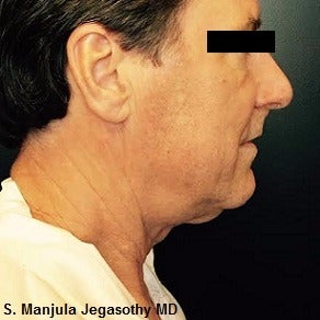 Non-surgical Necklift with Kybella® before 2255639