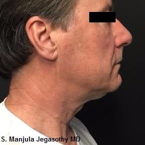 Non-surgical Necklift with Kybella® after 2255639