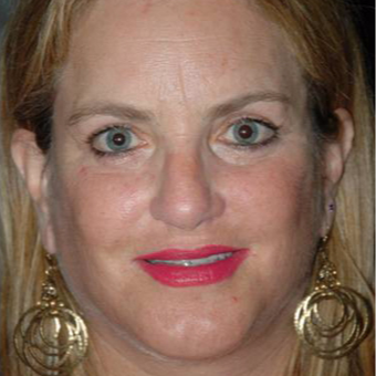 52 year old woman treated with Eyelid Surgery after 3710571