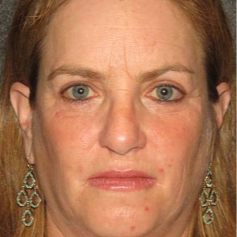 52 year old woman treated with Eyelid Surgery before 3710571