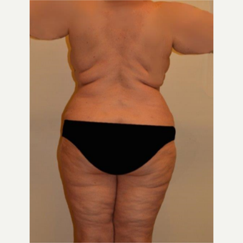 45-54 year old woman treated with Liposuction after 3658219